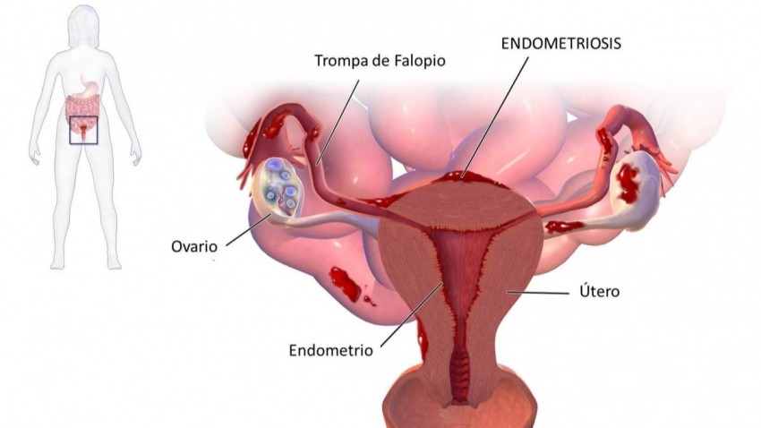 Endometriosis